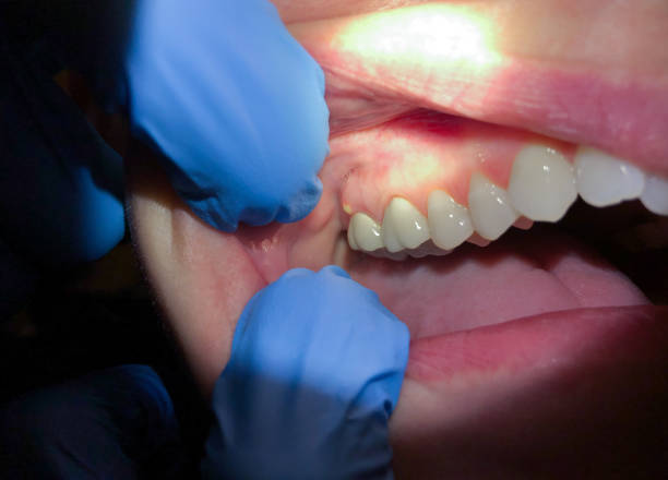 Best Emergency Gum Pain Relief  in St James City, FL